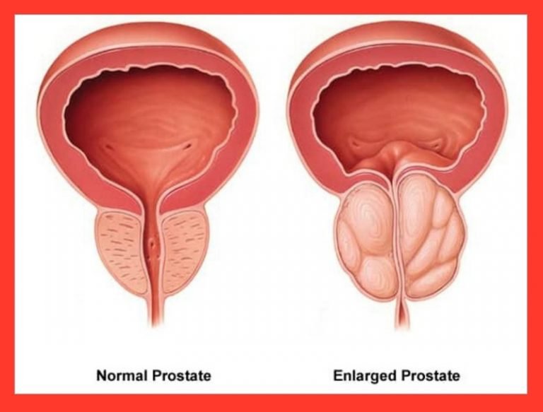 WASPADA MEEEN ..!Ini Pemicu, Gejala dan Tanda Kanker Prostat Pada Pria