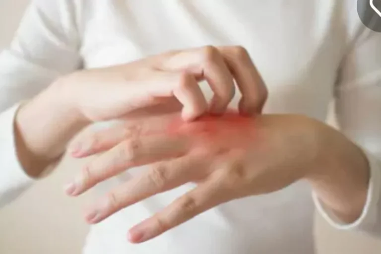 JANGAN ANGGAP REMEH..! Stres dan Cuaca Bisa Picu Psoriasis