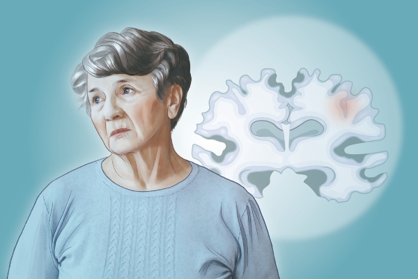 Alzheimer: Penyakit Neurodegeneratif Paling Umum, Ini Penyebabnya