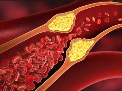 Aterosklerosis: Penumpukan Diam-diam yang Menyempitkan Arteri: Tanda-Tanda Peringatan yang Harus Diwaspadai